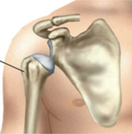 Dislocarea simptomele comune umăr și diagnostic