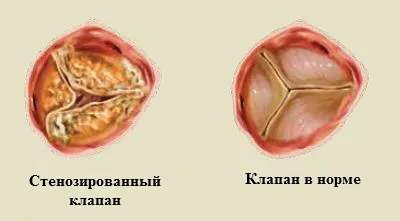 Boli ale valvelor inimii