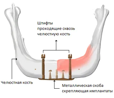 Зъбните импланти - зъбни импланти - Dental - списък на заболявания