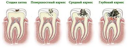 A fogak fáj a szülés után, morzsolódik, esik, érzékennyé válnak, tántorog, összeomlik, és megsárgult