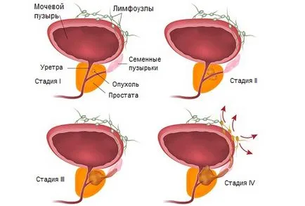 Senzație de arsură în cauzele de prostata si tactici ale sondajului