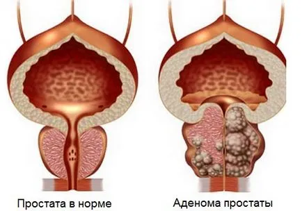 Senzație de arsură în cauzele de prostata si tactici ale sondajului