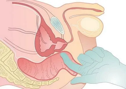 Senzație de arsură în cauzele de prostata si tactici ale sondajului