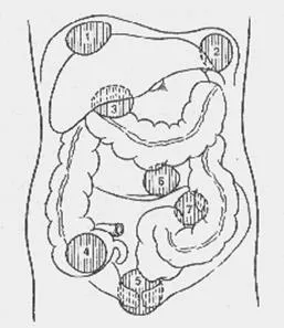 abcese abdominale