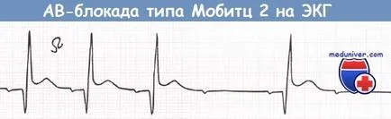 bloc atrioventricular în infarctul miocardic