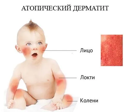 Az atópiás dermatitis gyermekkorban - tünetek megelőzésére és kezelésére, az atópiás dermatitisz