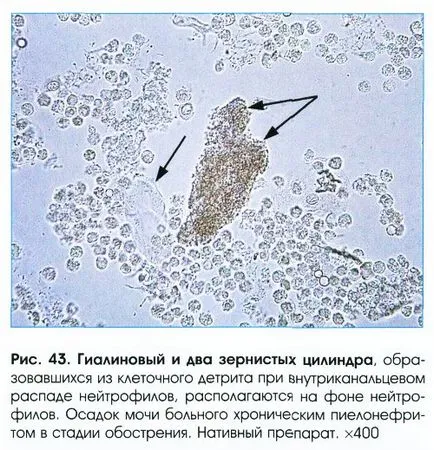 Анализ на урина цилиндри