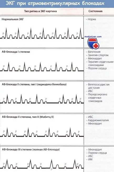 bloc atrioventricular în infarctul miocardic