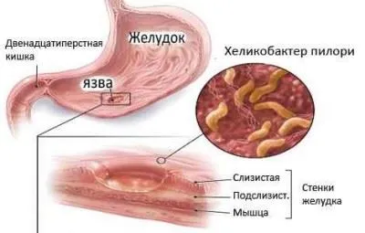 A Helicobacter pylori baktérium kezelése felnőttek és gyermekek antibiotikumok és népi jogorvoslati