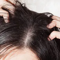 Boli ale scalpului tipuri, simptome și tratament