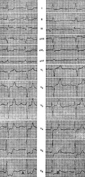 Blocada ramuri ale fasciculului His - electrocardiogramă in boala coronariana - practic