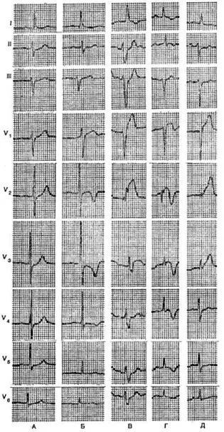 Blocada ramuri ale fasciculului His - electrocardiogramă in boala coronariana - practic