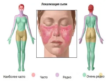 Cauzele bolii lupus, simptome și forme de tratament