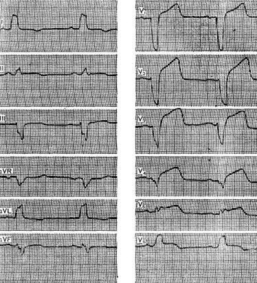 Blocada ramuri ale fasciculului His - electrocardiogramă in boala coronariana - practic