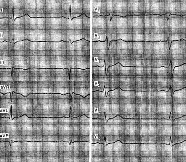 Blocada ramuri ale fasciculului His - electrocardiogramă in boala coronariana - practic