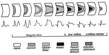 Blocada ramuri ale fasciculului His - electrocardiogramă in boala coronariana - practic