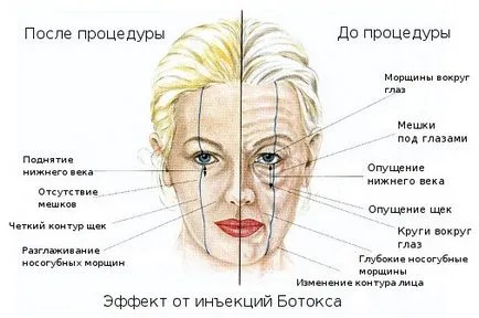 Botox hatás, ellenjavallatok, hatásai