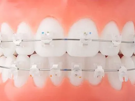 Braces in-ováció (innováció) modellben c, l, r