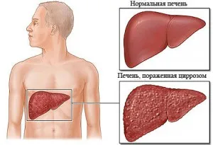 Заболяването се характеризира с хроничен алкохолизъм