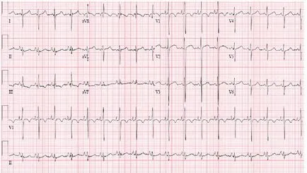 Mi tachycardia a betegség stádiumától, a kezelés és megelőzési módszerek