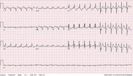 Mi tachycardia a betegség stádiumától, a kezelés és megelőzési módszerek