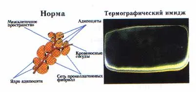 диагноза целулит