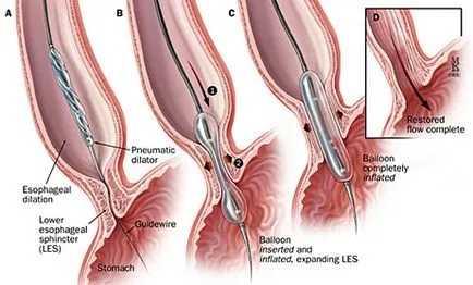 Dysphagia Esophageal kezelés