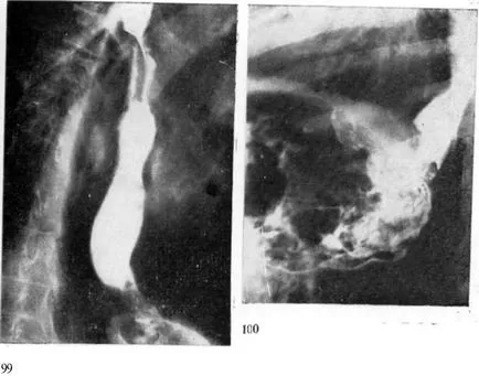 Diagnosticul de cancer esofagian - cancer al esofagului