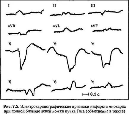 Diagnosticul de infarct miocardic cu bloc de ramură