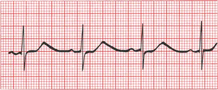 ECG - medicament viu