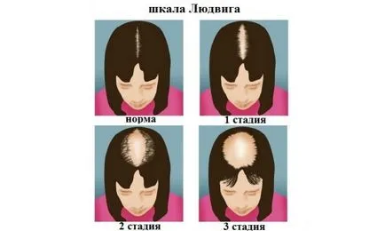 Tratamentul eficient al alopeciei la femei la domiciliu