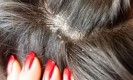 Tratamentul eficient al alopeciei la femei la domiciliu