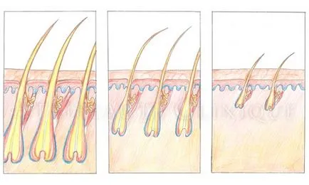 Tratamentul eficient al alopeciei la femei la domiciliu