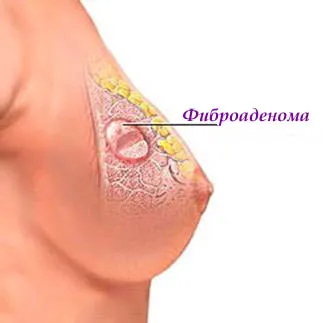 Fibroadenóma - Okok fibroadenóma - fibroadenóma tünetek