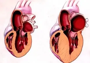 Hipertrofia tratamentului inimii, prevenirea, tipuri, si centru de cardiologie funcțional