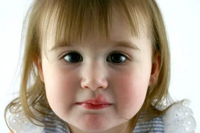 Херпес на устните на детето, отколкото да се лекува в 1 - 3 и 4 години