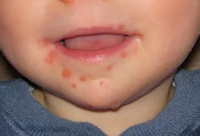 Херпес на устните на детето, отколкото да се лекува в 1 - 3 и 4 години
