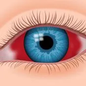 picături oculare de conjunctivita alergică la adulți