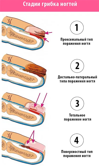 Irunine от гъбички на ноктите ревюта, инструкции за употреба цени и противопоказания