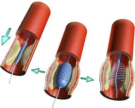 A Plavix használatát követően stenting