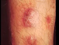 Yododerma - cauze, simptome, diagnostic și tratament