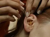 Hogyan lehet megszabadulni a fülzsír a fül az otthoni, a hagyományos orvoslás