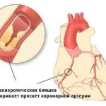 Hogyan kell kezelni a szívkoszorúér-betegség
