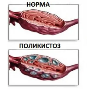 Как за лечение на поликистозни яйчници, съвети за жени