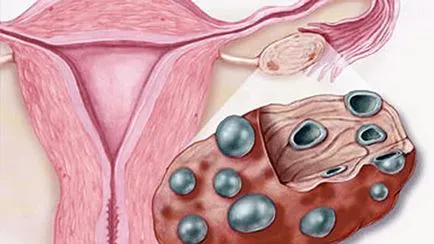 Как за лечение на поликистозни яйчници, съвети за жени