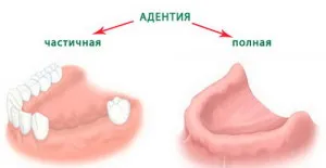 Edentiára - részleges és teljes, az elsődleges és másodlagos Edentiára, fotók