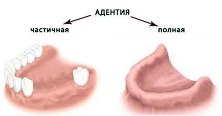 Edentiei - orice proteză pune în absența dinților - portalul dentar