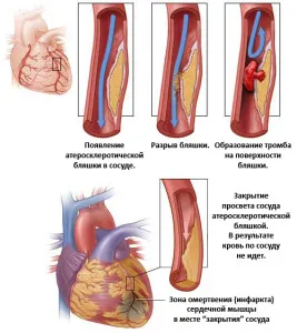 Hogyan ismerjük fel a szívinfarktust