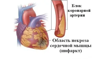 Cum de a recunoaște un atac de cord