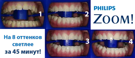 Апарат за избелване увеличение 4 (САЩ) -equipment клиника 2